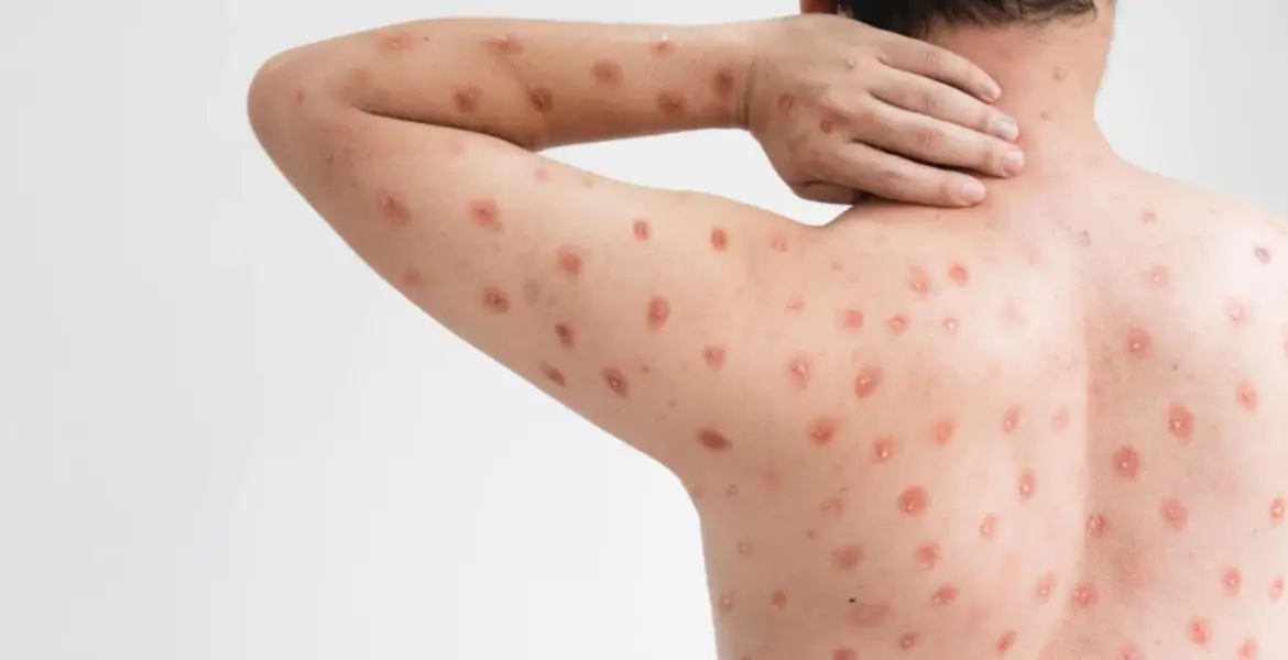 Monkeypox e o “manual” das pandemias: quando é hora de soar o alarme?